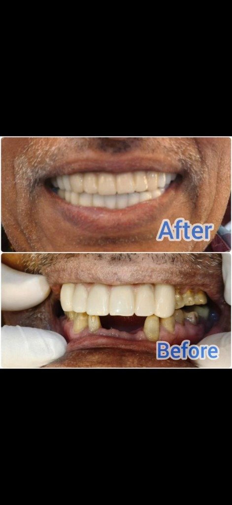 3D Full Arch Digital Dental Implants Transformation