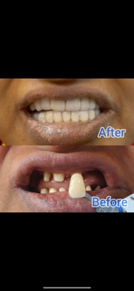 Porcelain Veneers & Smile Makeover Transformation