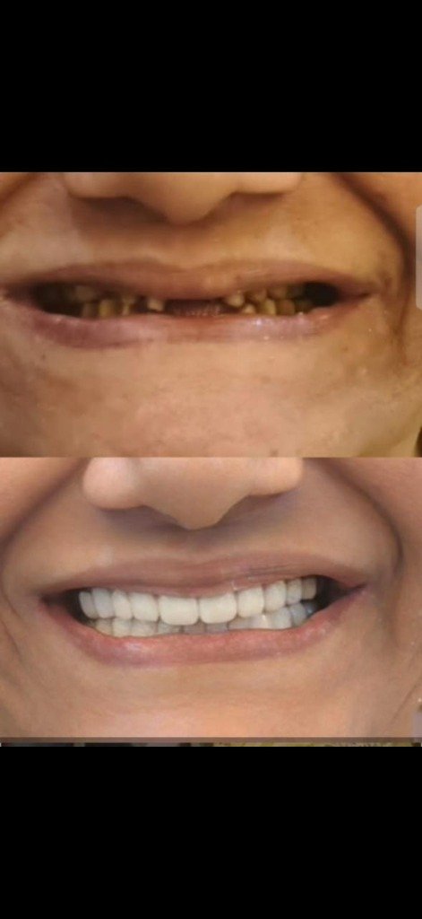 Full Mouth Rehabilitation Transformation