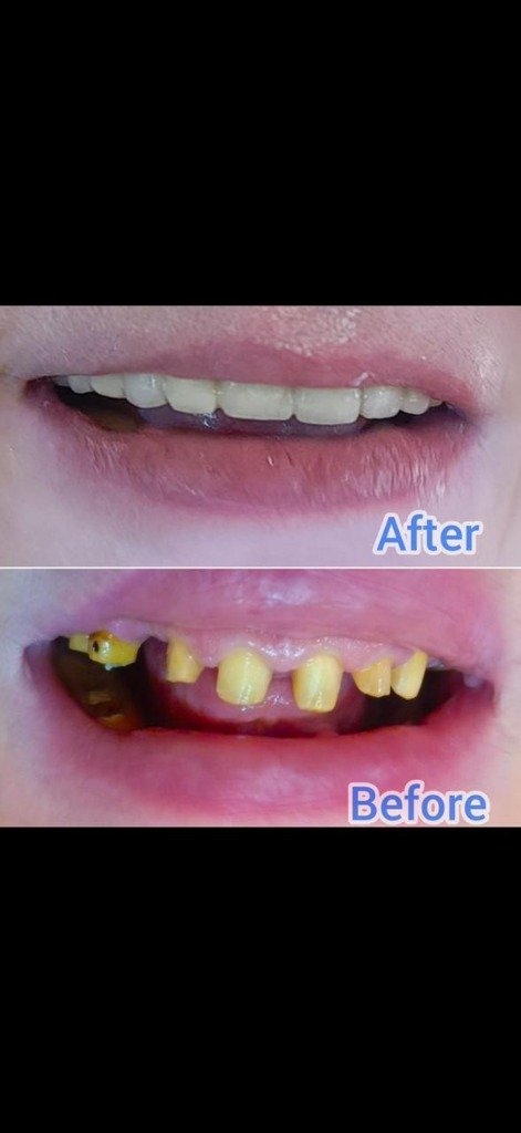 Zirconia Crowns & Bridges Transformation